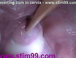 Flier sex cream cum adjacent to cervix nigh dilatation cookie speculum